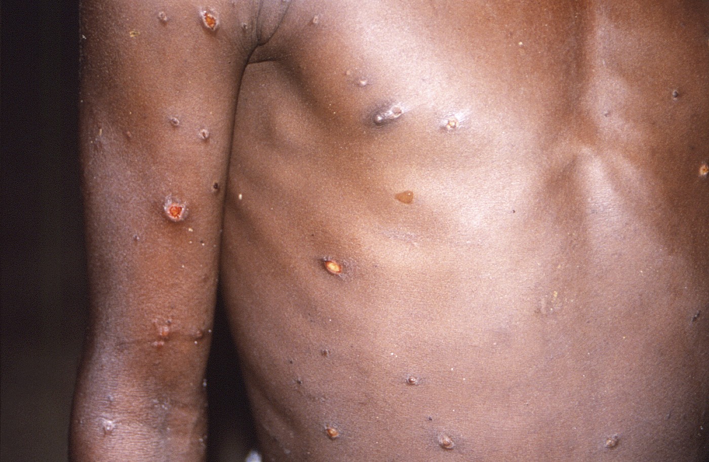 Noua tulpină a mpox îngrijorează cercetătorii. Se modifică mai rapid decât se aşteptau specialiștii
