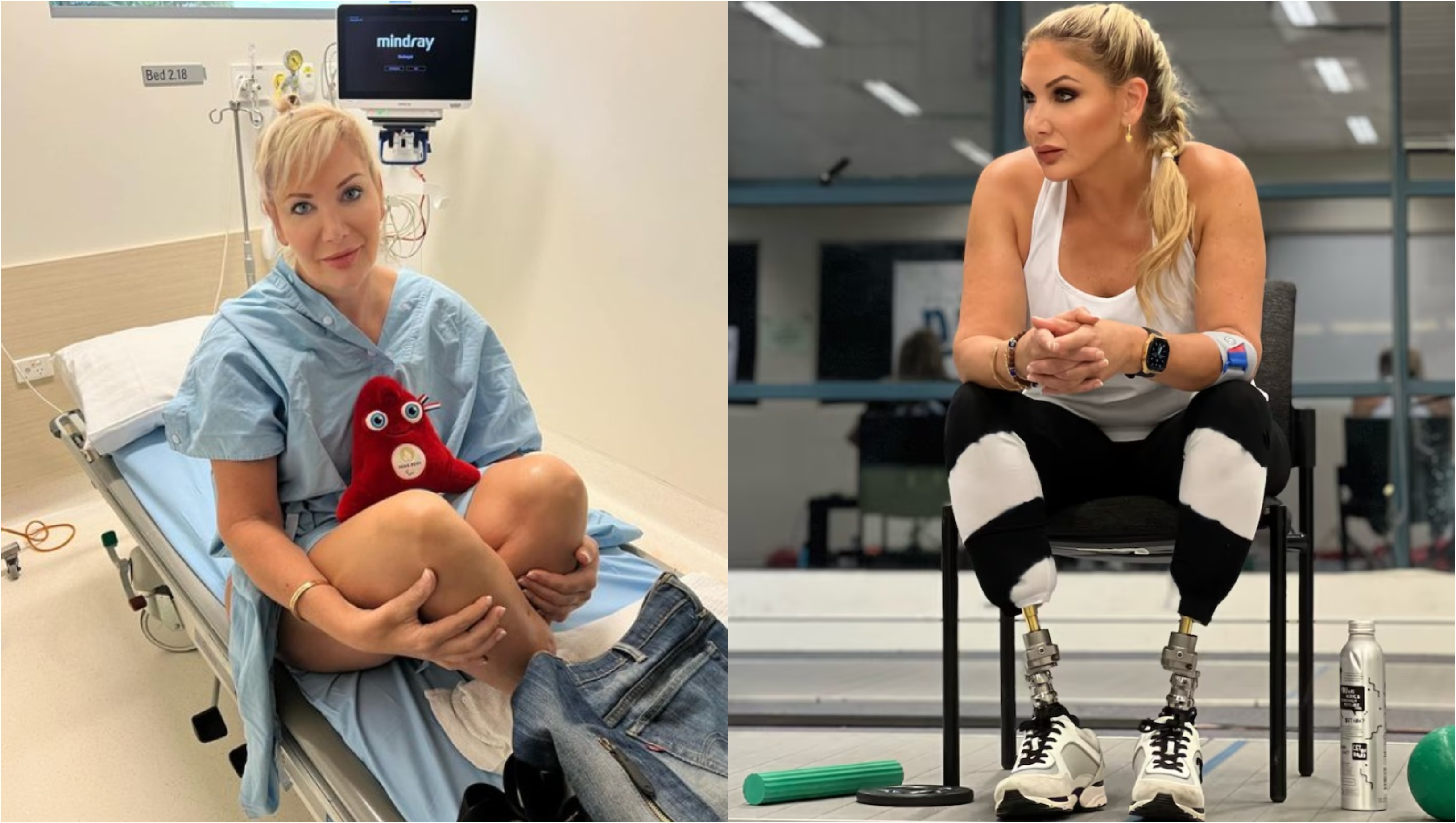 O femeie a fost în comă două săptămâni, a suferit 47 de operații și și-a pierdut ambele picioare de la o mușcătură de țânțar