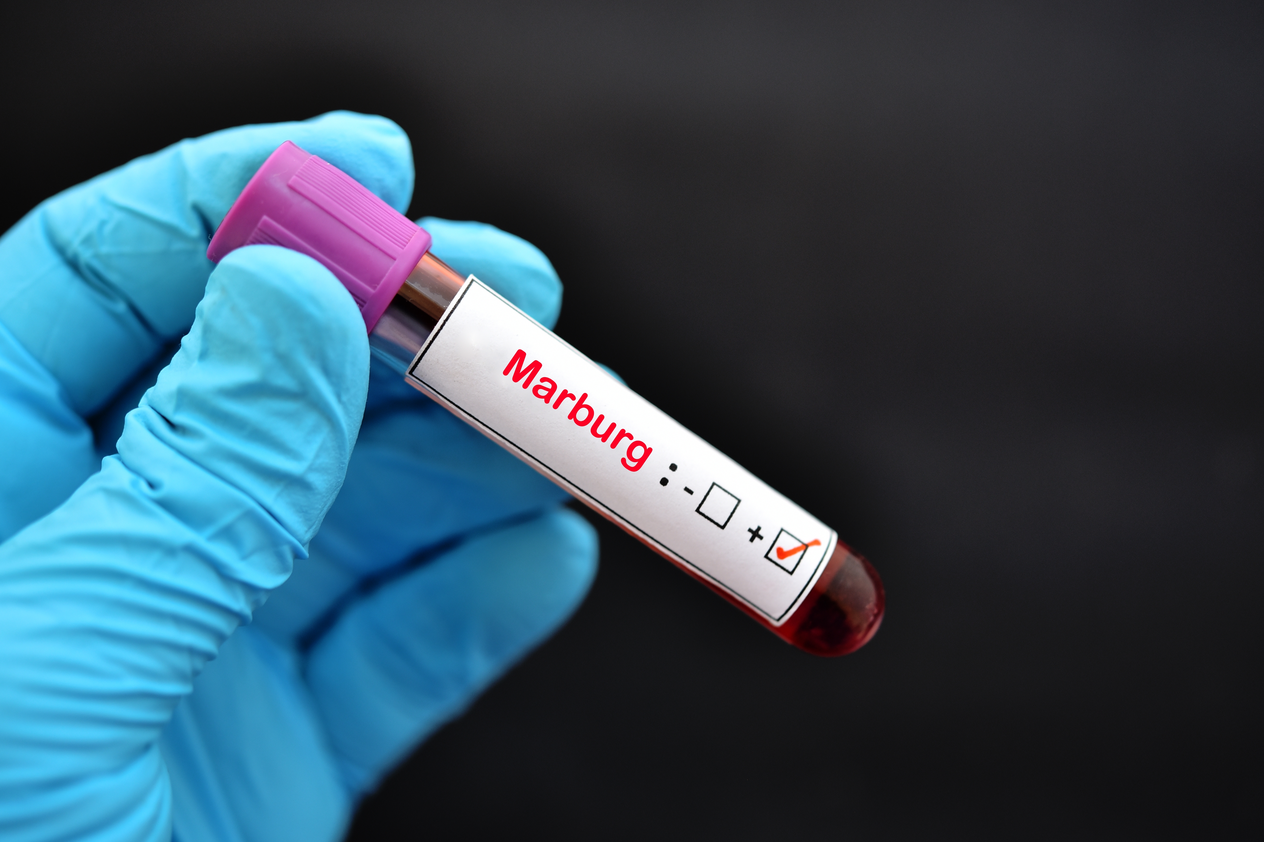 Cât de periculos este virusul Marburg, comparat cu boala Ebola. Ce spune medicul infecționist despre o posibilă infectare și în România