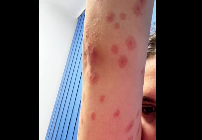 O studentă a ajuns la spital cu zeci de înţepături de ploşniţe după ce s-a cazat în cămin în Regie. Reacția Universității din București