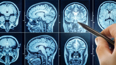 tumoare creier inteligenta artificiala