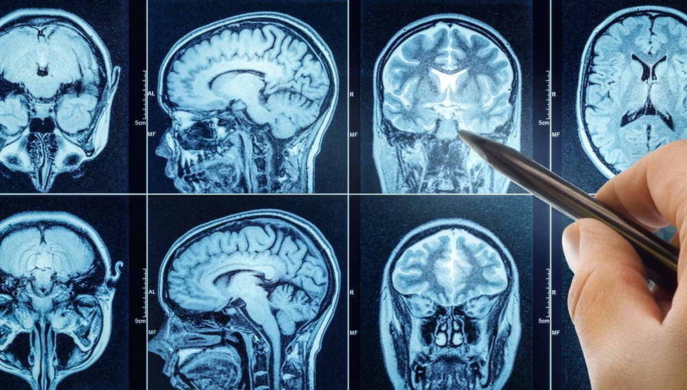 Cum ar putea inteligența artificială să revoluționeze diagnosticarea tumorilor pe creier (studiu)