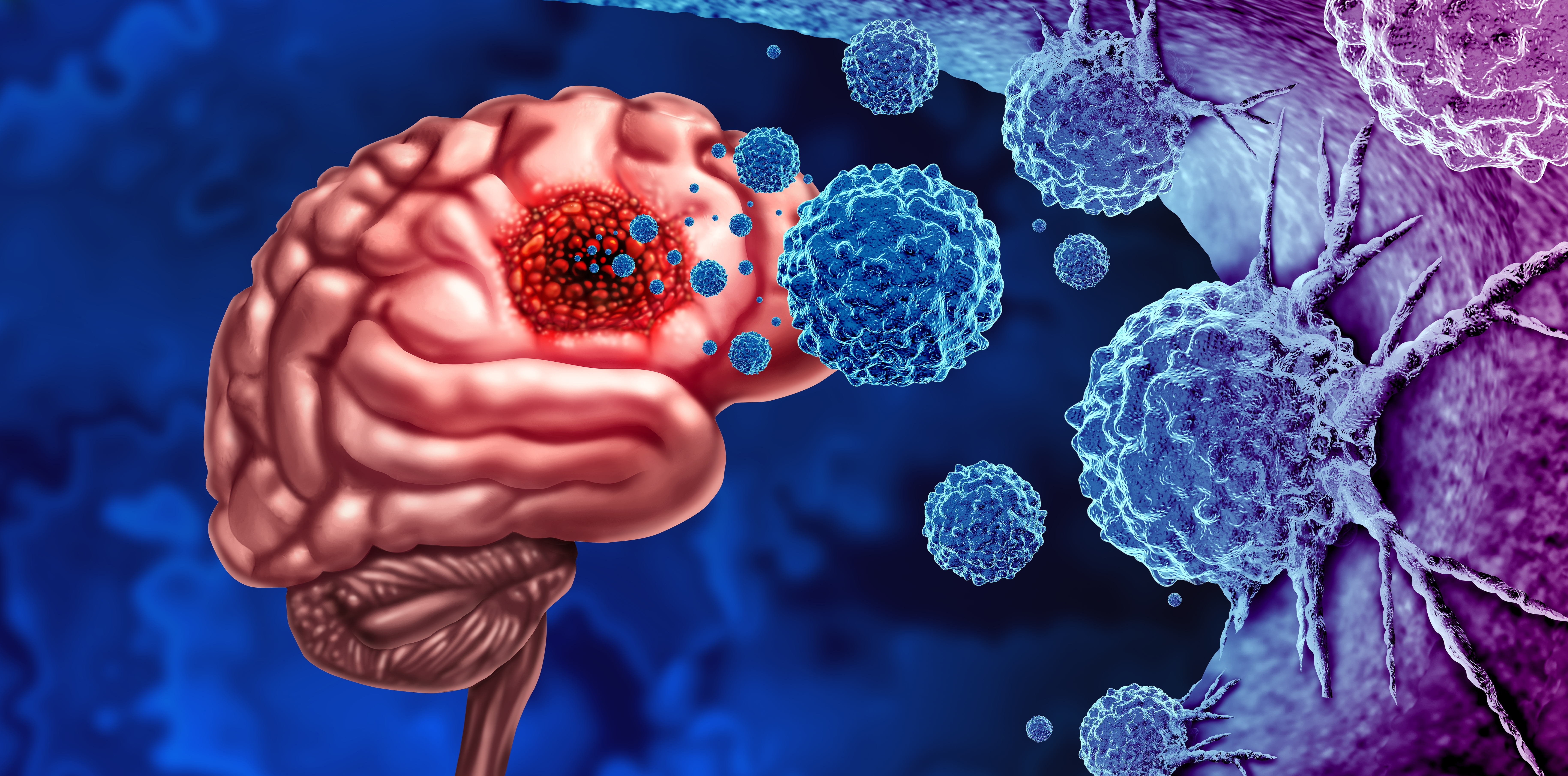 Efectele unui nou tratament pentru cel mai agresiv tip de cancer cerebral: Prelungeste viața pacienților și reduce durata procedurilor