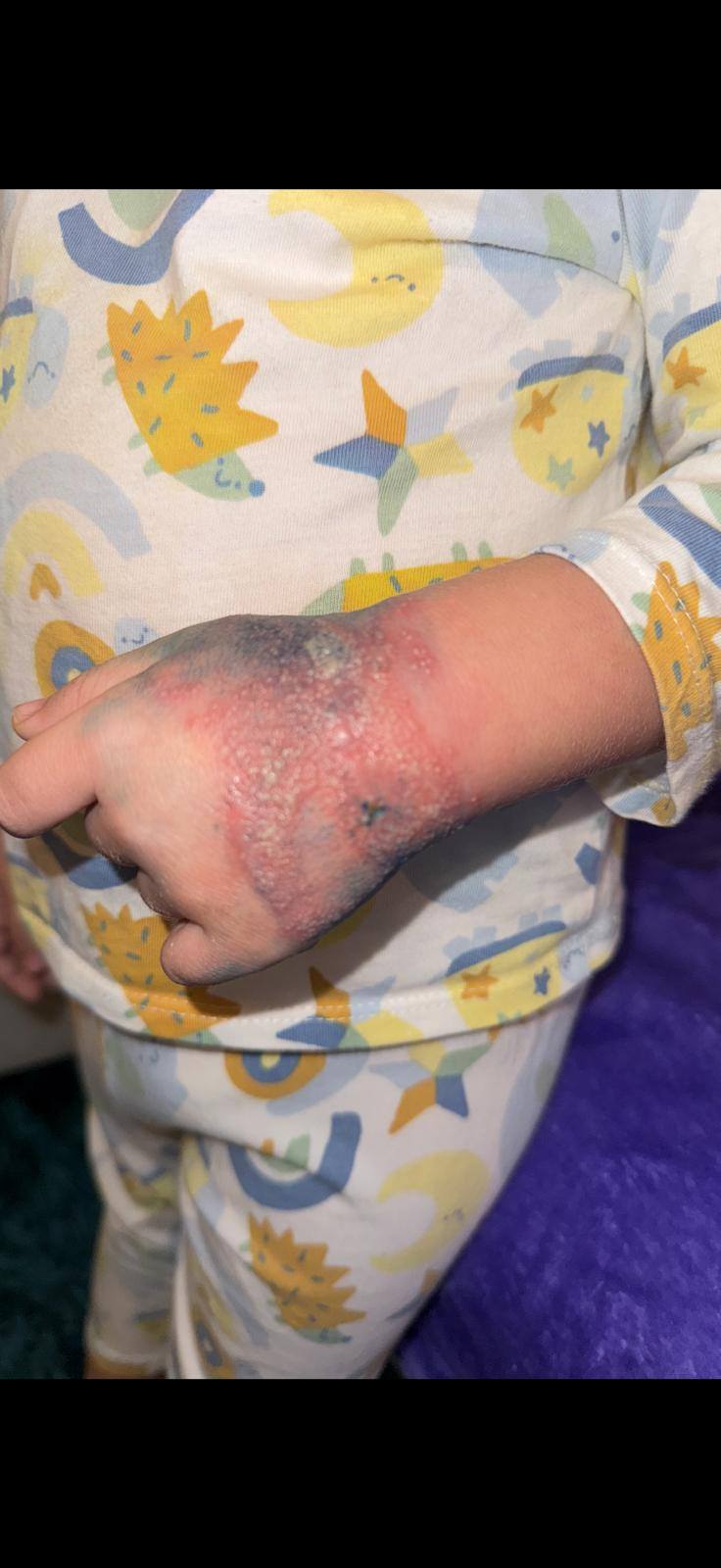 Anchetă la Spitalul Râmnicu Vâlcea, după imaginile cu un copil cu mâna tumefiată, din cauza unei branule neschimbate de 4 zile