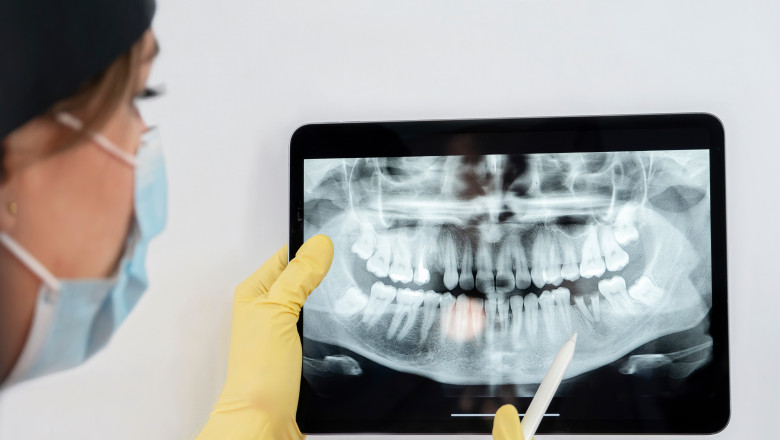 Legătura neașteptată dintre Alzheimer și boala gingiilor: Ce au descoperit cercetătorii