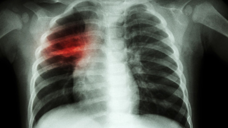 Pulmonary Tuberculosis ( Chest X-ray of child : show patchy infiltration at right middle lung )