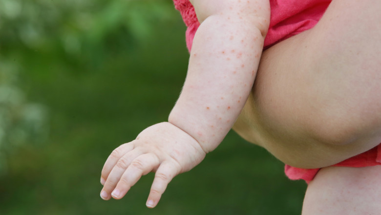 SUA se confruntă cu cea mai gravă epidemie de rujeolă din secolul XXI. Secretarul de stat Robert Kennedy Jr., acuzat că o alimentează