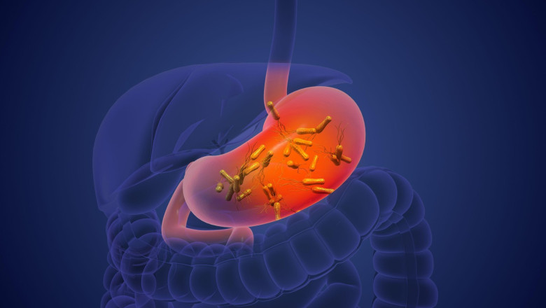 Bacteria Helicobacter Pylori ar putea provoca milioane de cazuri de cancer de stomac în următorii ani (studiu)