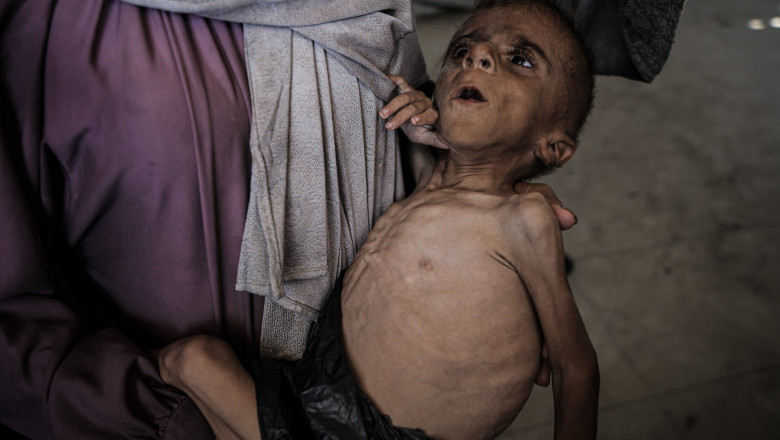 Unicef: peste 7.000 de copii, cu vârste sub 5 ani, din Gaza au fost incluși în programe de recuperare din cauza malnutriției acute
