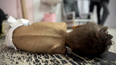 Children suffering from malnutrition in Gaza receive treatment under limited conditions