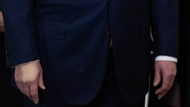 Vânătaia cosmetizată a lui Donald Trump. Foto- Profimedia