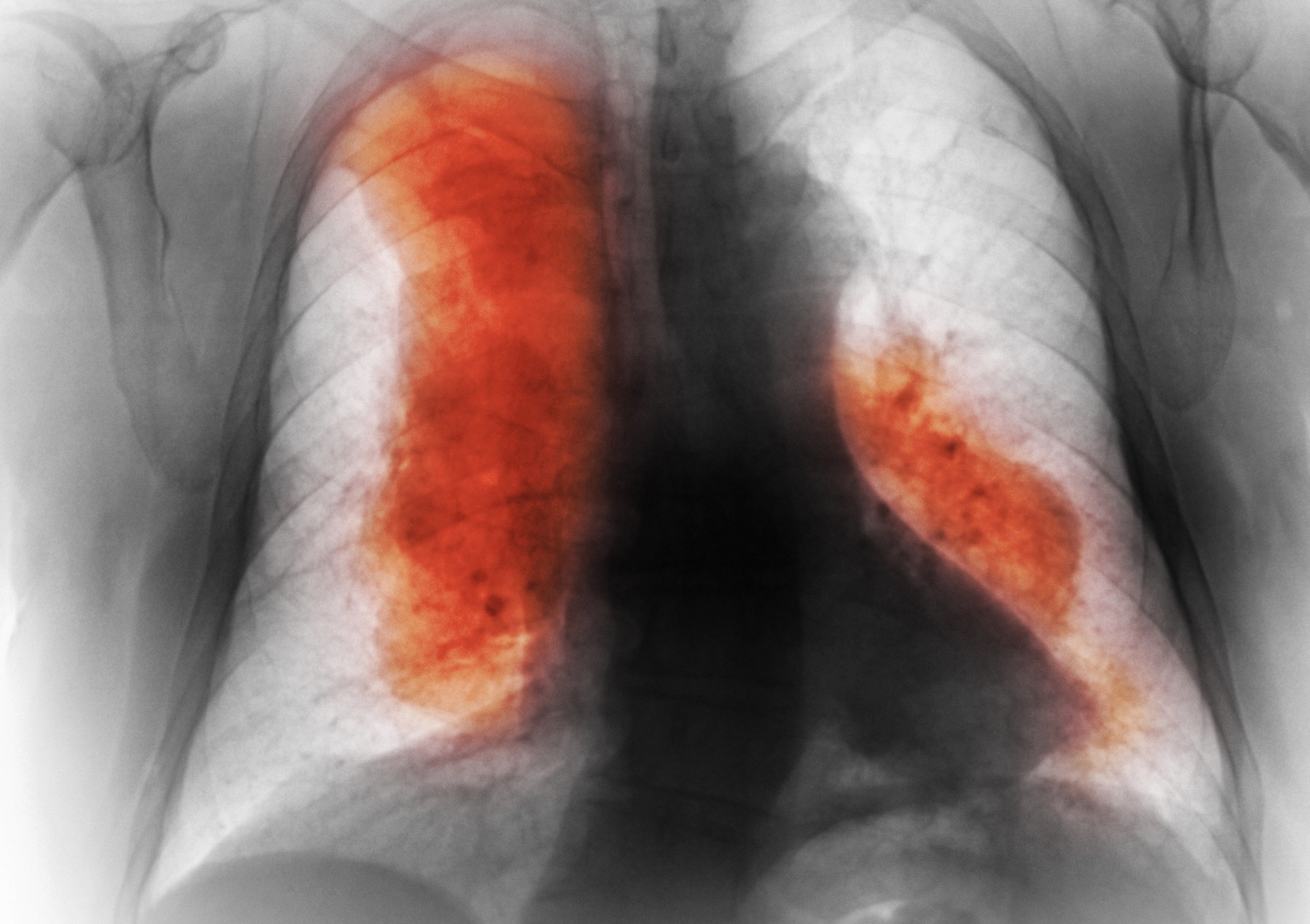 Numărul deceselor cauzate de cancer ar urma să crească semnificativ până în 2050. Cele mai frecvente și cele mai mortale (studiu)