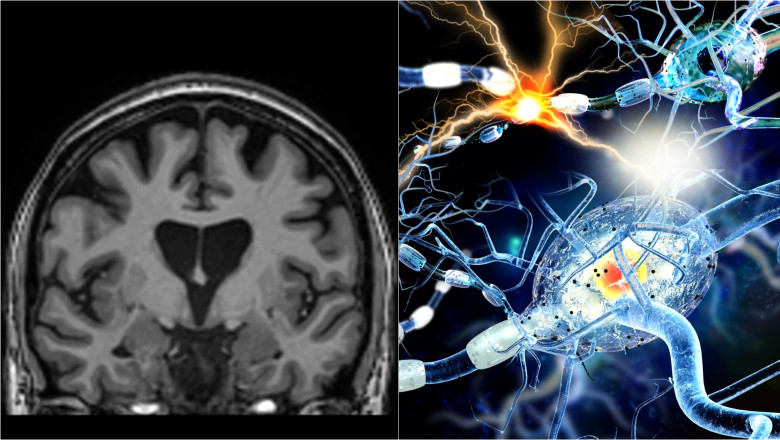 Studiu: Covid-19 poate lăsa modificări detectabile în creier, chiar şi după recuperare completă