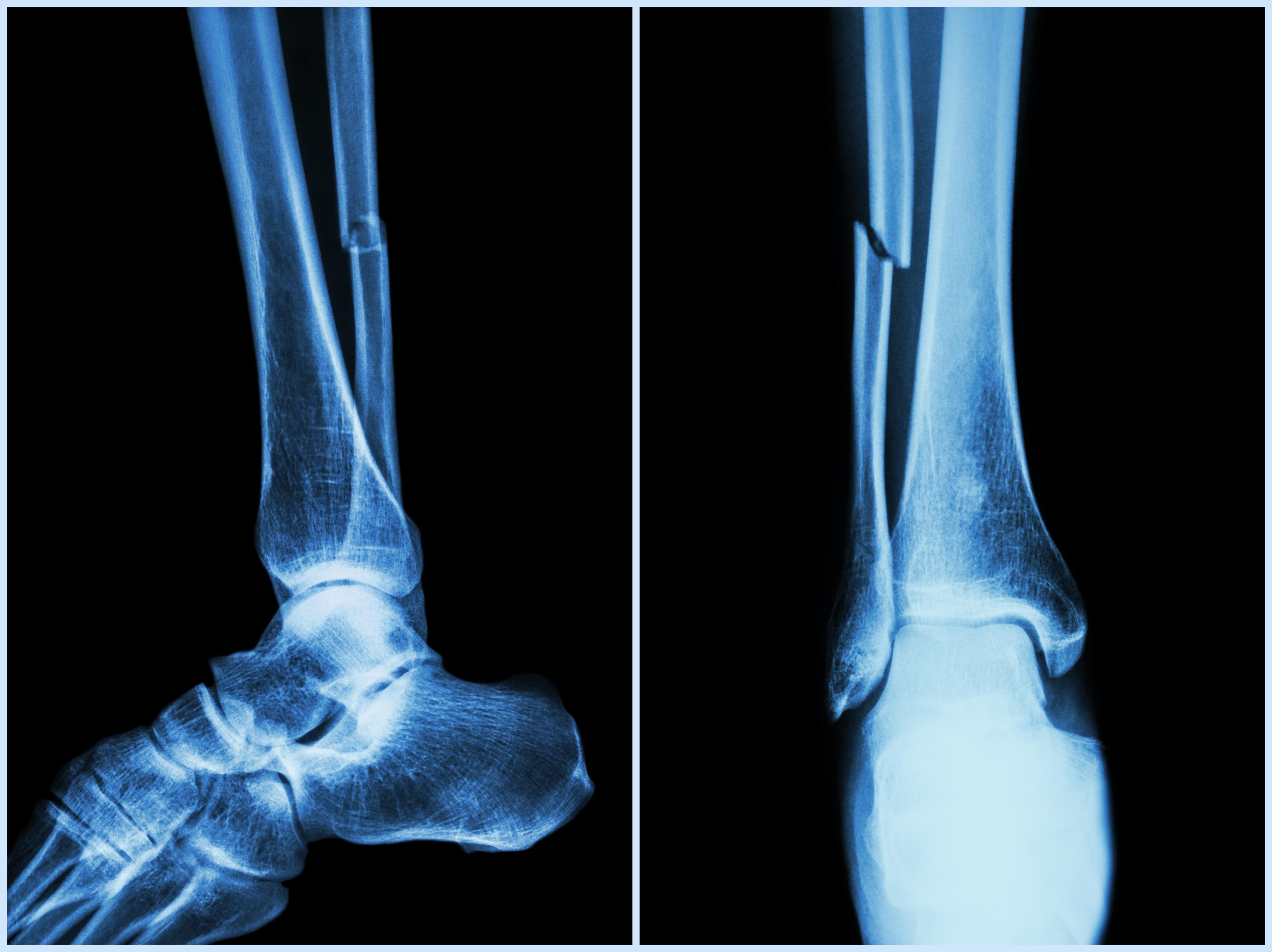 Fracturi vindecate în câteva minute: un lipici pentru oase, soluția găsită de cercetătorii chinezi