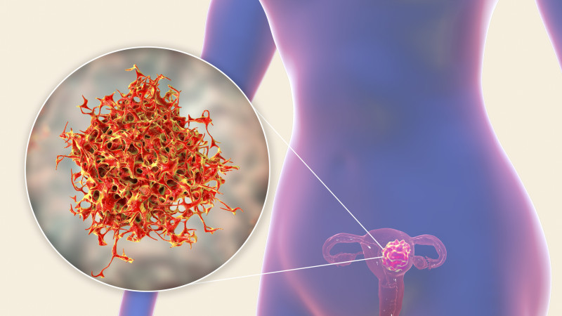 cancer uterin ovare
