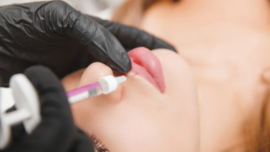 injectie cu acid hialuronic in buze