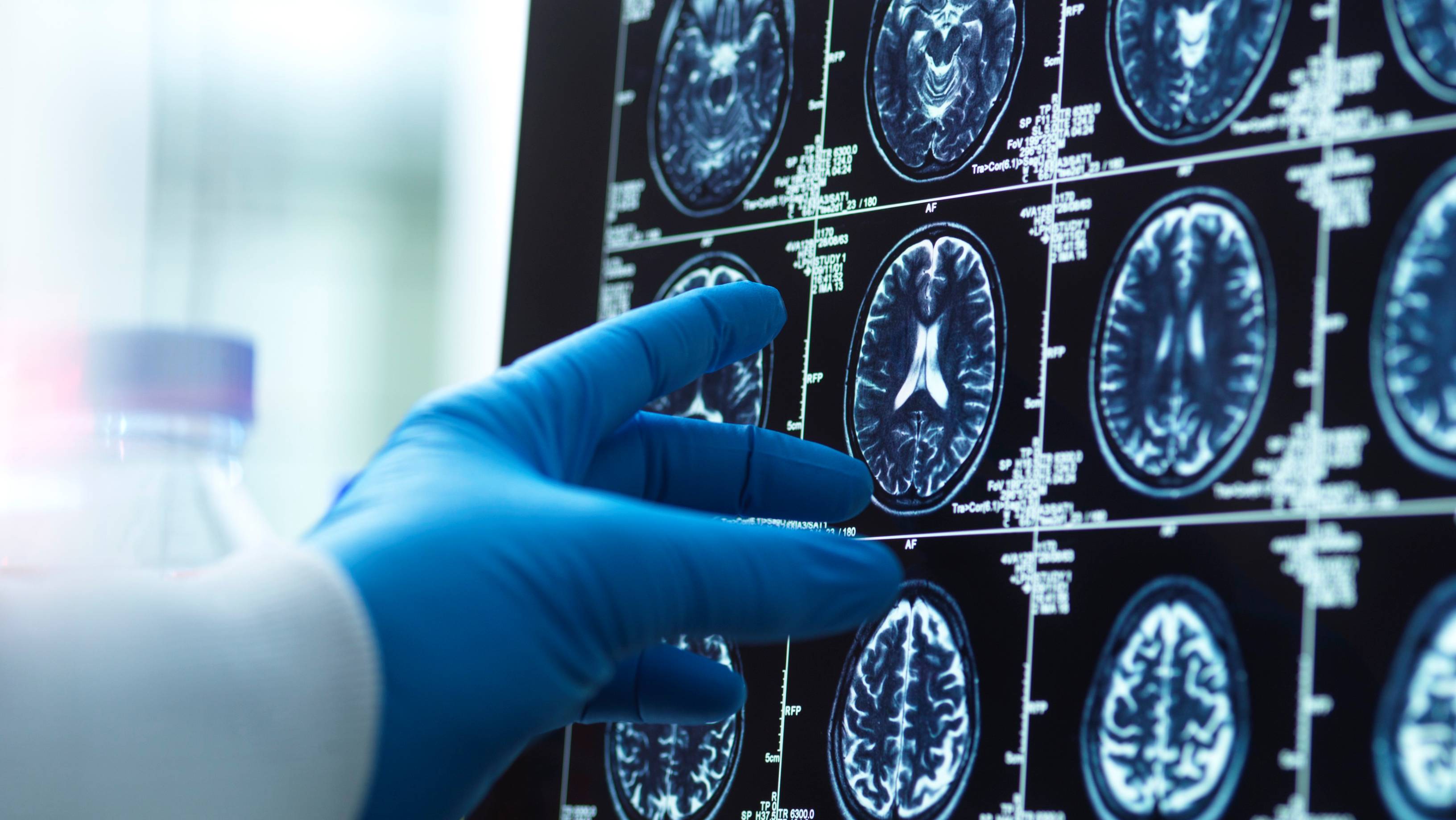 Creierul bărbaților se micșorează mai repede decât cel al femeilor pe măsură ce îmbătrânesc, arată un studiu