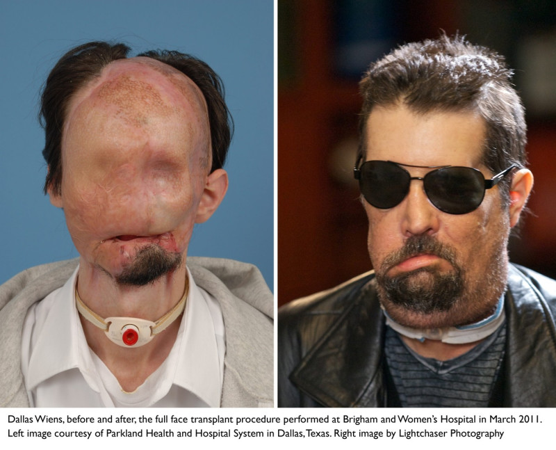 Dallas Wiens full face transplant