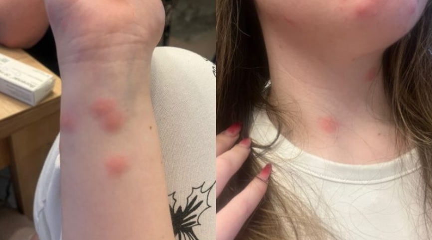 O tânără a ajuns la spital după ce a fost mușcată de ploșnițe într-un tren CFR. Familia a făcut plângere