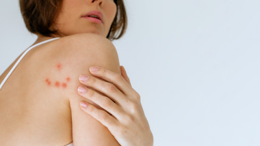 Cum arată ploșnițele. Foto Getty Images