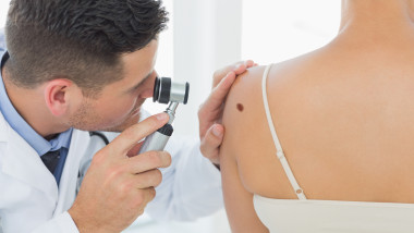 Cum recunoști alunițele care pot deveni canceroase. Foto Getty Images