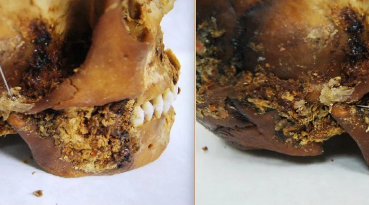 Descoperire uluitoare în Siberia: O femeie scită a supraviețuit unei operații complexe la maxilar acum 2.500 de ani