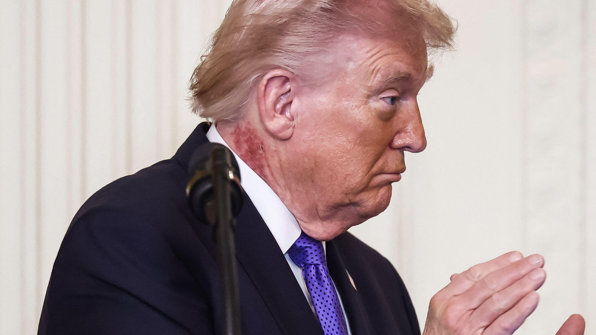 Noi întrebări despre starea de sănătate a lui Donald Trump. Ce este pata roșie apărută pe gâtul președintelui american