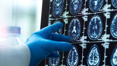 scanare creier RMN creier