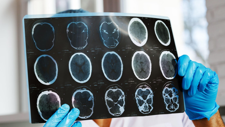 Male doctor examines MRI brain scan of a patient