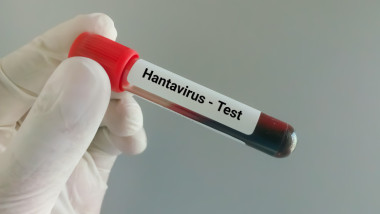 test de hantavirus