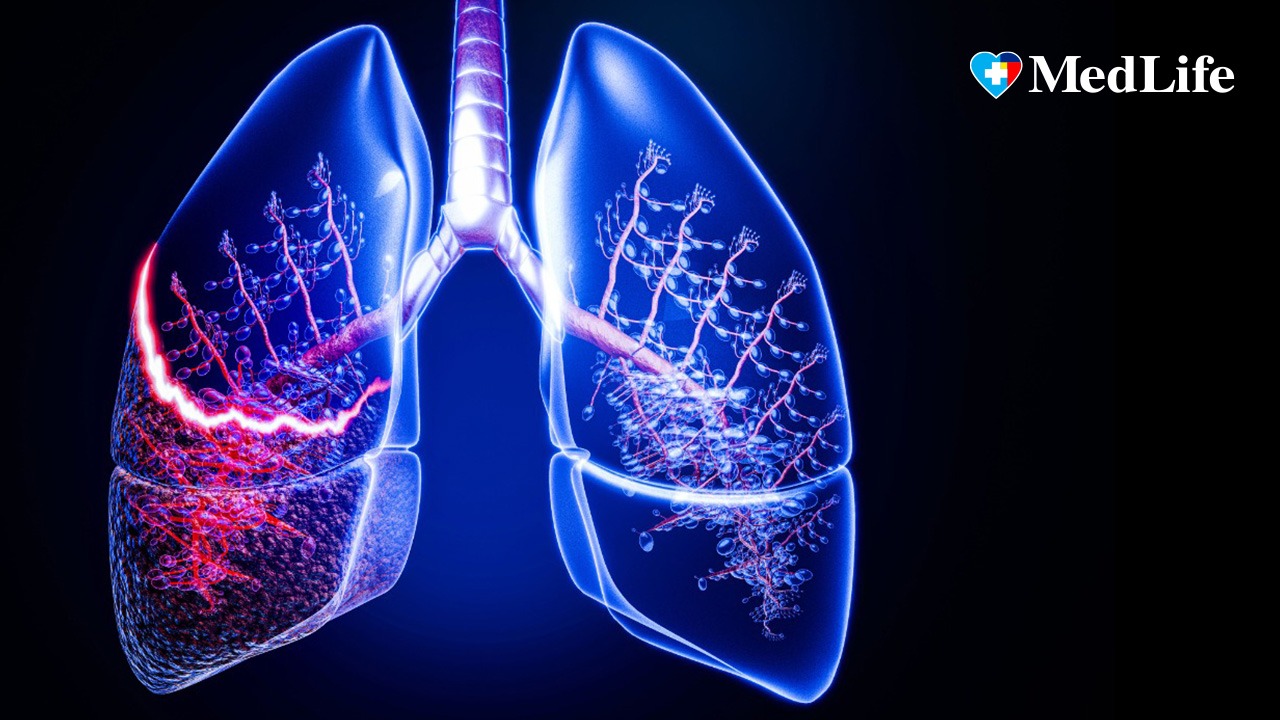 „Tusea care durează mai mult de 2 luni trebuie investigată”. Semnele bolilor pulmonare care nu ar trebui ignorate