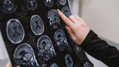 Close-up,Mri,Of,The,Brain,,The,Doctor,Studies,And,Analyzes