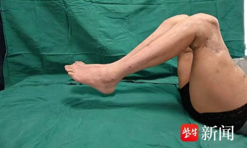 China se laudă cu o premieră medicală: operație reușită de reatașare a ambelor picioare. După cât timp a putut merge pacientul 2 pacient china picioare reatasate