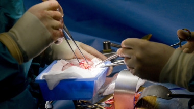 Kidney transplant surgery