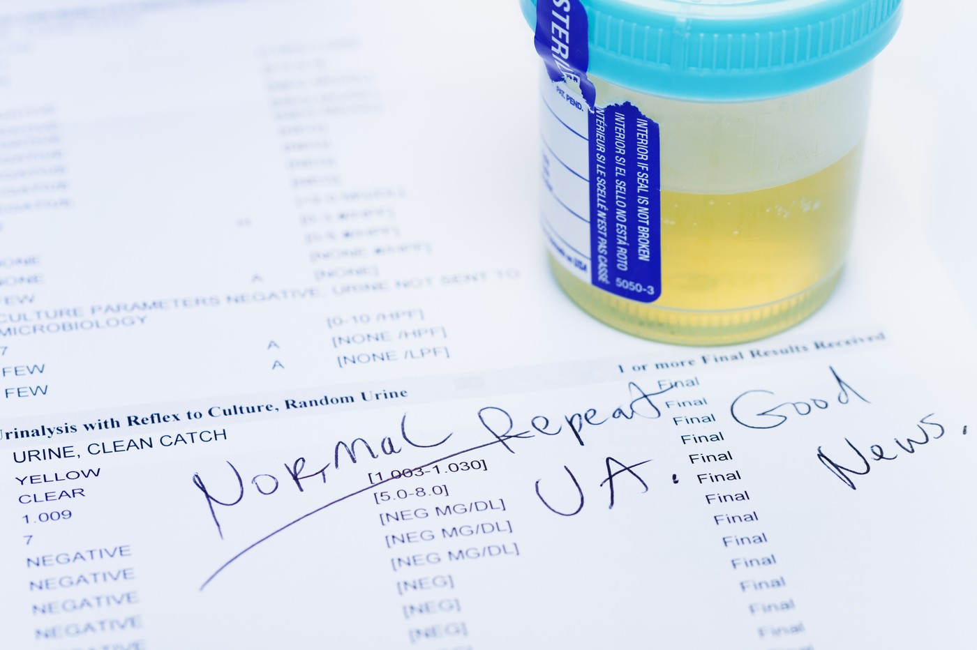 Un test de urină poate depista 9 din 10 cazuri de cancer de vezică urinară