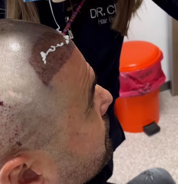 Cum arată Adrian Mutu după implantul de păr. "Briliantul" a revenit la look-ul de acum 20 de ani