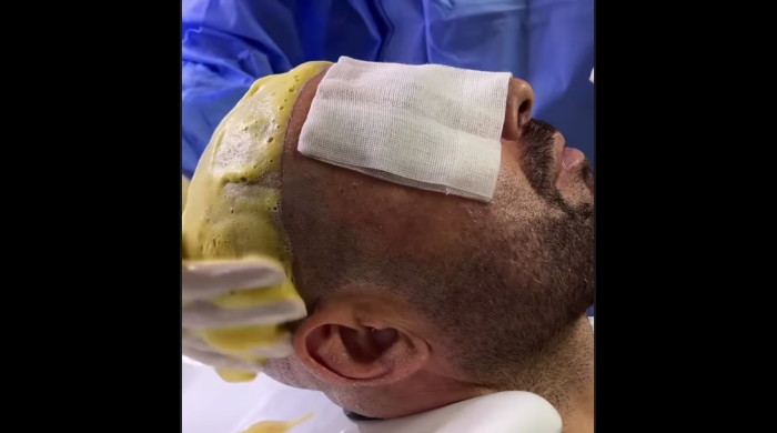 Adi Mutu și-a făcut implant de păr / Foto: Captură Instagram dr.cinikhospital