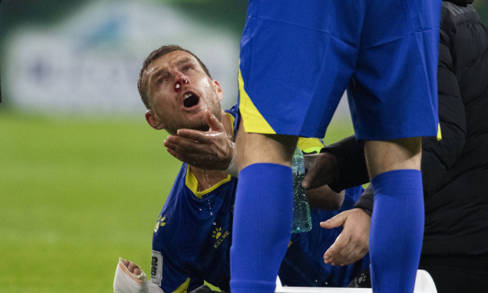 11 Edin Džeko with nose bleading
