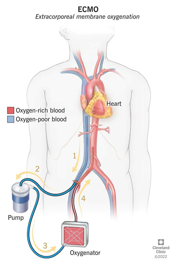 21722-ecmo-illustration