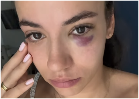 Cu ochiul învinețit, Teodora Meluță a dezvăluit ce a pățit