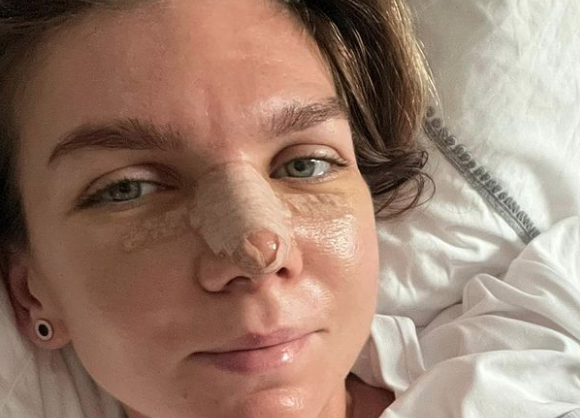 Cum arată Simona Halep la o săptămână de la operația suferită la nas