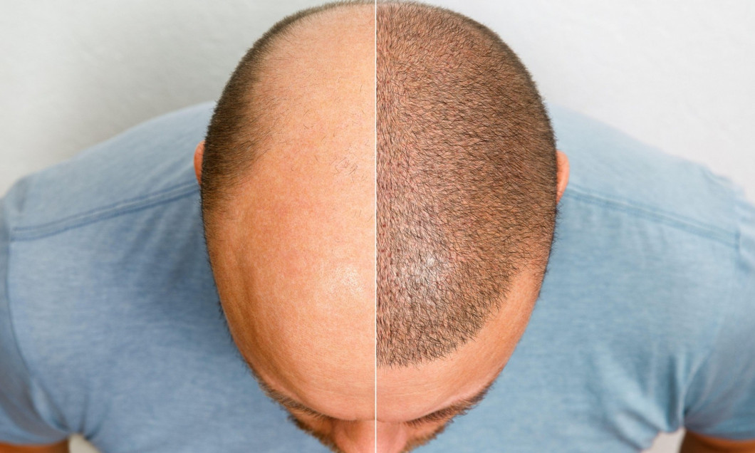 The head of a balding man before and after hair transplant surgery. A man losing his hair has become shaggy. An advertising poster for a hair
