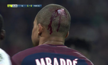 Mbappe accidentare