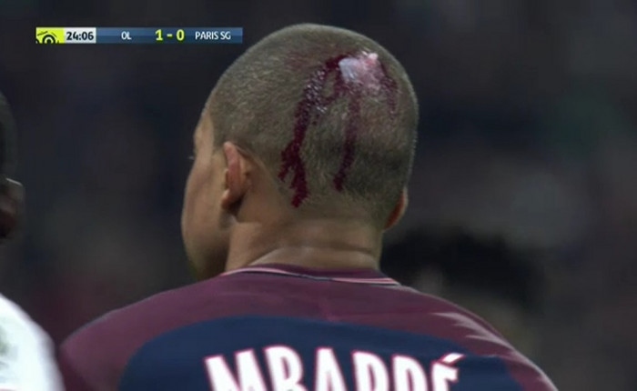 Mbappe accidentare