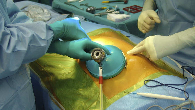 operatie transplant mediafax