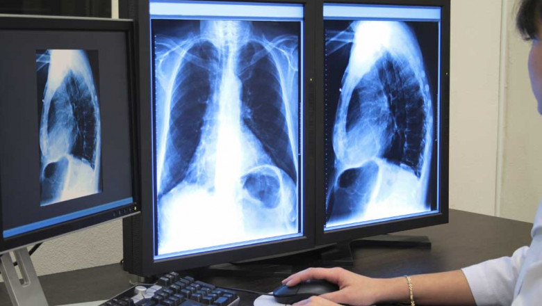Avertisment OMS. Pandemia de COVID riscă să agraveze bilanțul unei alte boli pulmonare, pentru care există tratament