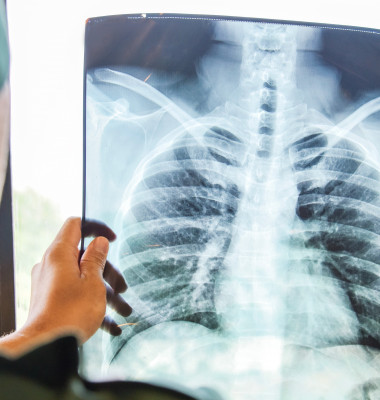 radiografie pulmonară