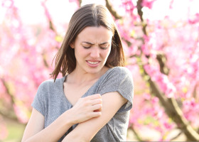 Stressed,Woman,Scratching,Itchy,Arm,After,Insect,Bite,In,A