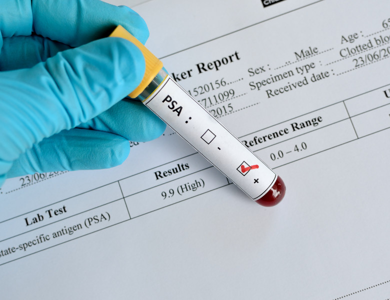 Blood,Sample,With,Psa,(prostate-specific,Antigen),Result