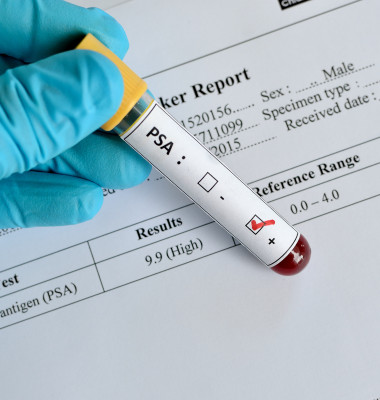 Blood,Sample,With,Psa,(prostate-specific,Antigen),Result